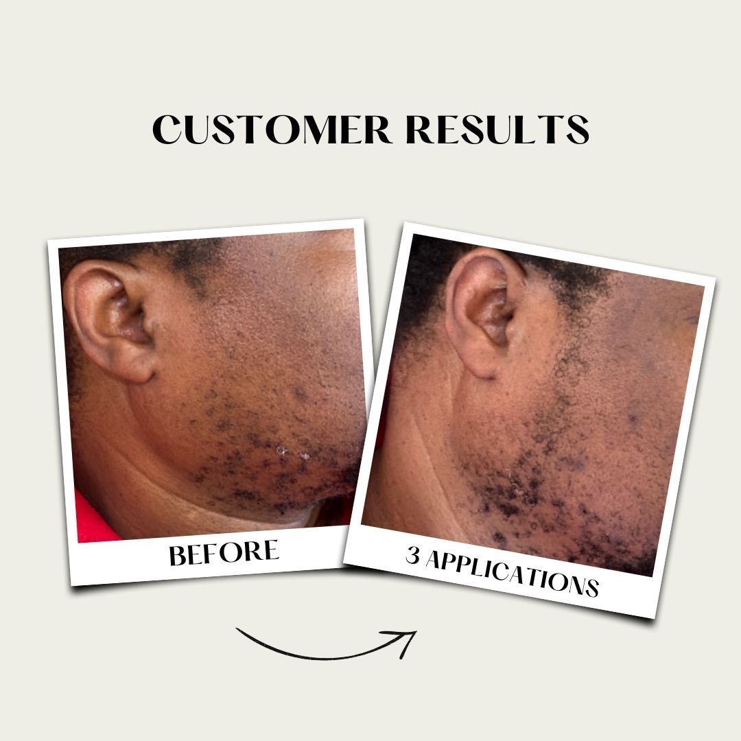 17BLEND Follicle Stimulator